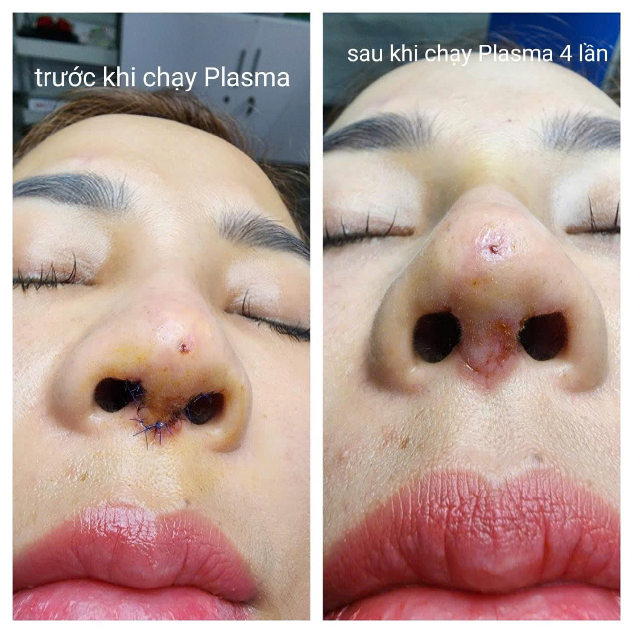 Sau khi nâng mũi có nên chiếu Plasma lạnh không?